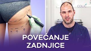 Povećanje zadnjice sopstvenim masnim tkivom ili implantima - gde je razlika? | Dr Miloš Zvicer