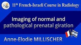 Imaging of normal and pathological prenatal giration - Anne-Elodie MILLISCHER