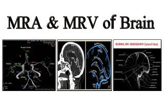 MRA & MRV of Brain