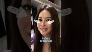 Rhinoplasty and Chin Surgery Review | VIP Plastic Surgery Korea