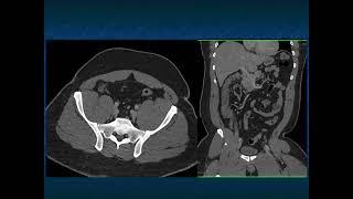 CT Evaluation of the Appendix: Appendicitis and Beyond - Part 1