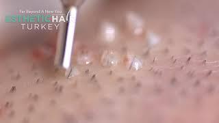 HOW TO EXTRACT THE GRAFTS IN ESTHETIC HAIR TURKEY