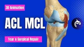 ACL (Anterior Cruciate Ligament) MCL (Medial Collateral Ligament) Tear and Repair - 3D Animation