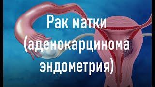 Рак матки (аденокарцинома эндометрия)