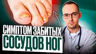 5 ПРИЗНАКОВ ЗАБИТЫХ СОСУДОВ НОГ. Как проверить дома без врача?