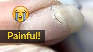 Fixing Broken Nail with Acrylic