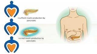 Diabetes - The different types of diabetes and its treatment