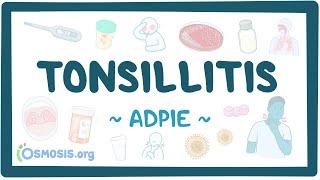 Tonsillitis: Nursing Process (ADPIE)