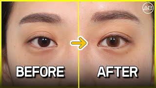 revision double eyelid surgery review | Before & After | AB Plastic Surgery Korea