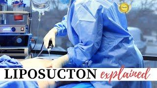 What To Expect With Liposuction at Imagen Body Sculpting