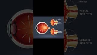 Can vision be restored after optic nerve damage?