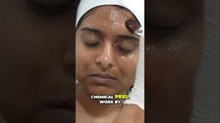 Chemical Peeling Treatment in Bangalore #skincare