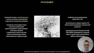 Синдром обратимой церебральной вазоконстрикции. д.м.н., проф. Кулеш Алексей Александрович