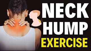 Neck hump exercises at home (Hindi) | Buffalo hump removal Exercise | How to fix Neck Hump (Fast)