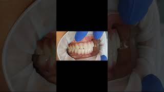 Definitive full arch implant prosthesis  milled GCam teeth set for basal dental implants!