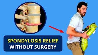 Spondylosis Treatment Without Surgery  Spondylolisthesis Causes