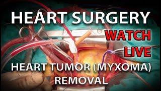 Heart Surgery | Heart Tumor (Myxoma) Removal | Wach from the Surgeon's View in 4K