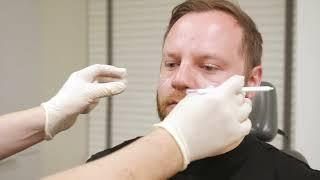 Male eye bags - treatment with dermal filler