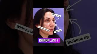 Natural Rhinoplasty Results | Avance Plastic Surgery Institute: Dr. Erez Dayan | Reno, NV