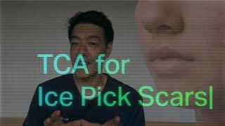 Treatments for Ice pick acne scars | Dr Davin Lim