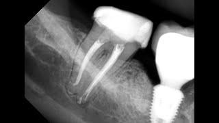Вывод №6 Обтурируйте канал постоянно как только он готов! Лечение кисты зуба. Киста зуба Периодонтит