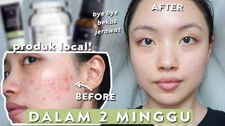 Bekas Jerawat hilang dalam 15 hari!  SKINCARE LOKAL TERJANGKAU - ACNE PRONE SKIN