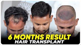 Hair Transplant in Chennai | Best Results & Cost of Hair Transplant in Chennai