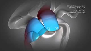 Shoulder Arthroscopy - Rotator Cuff Repair