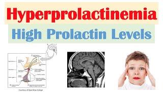 Hyperprolactinemia (High Prolactin Levels) | Causes, Signs & Symptoms, Diagnosis, Treatment