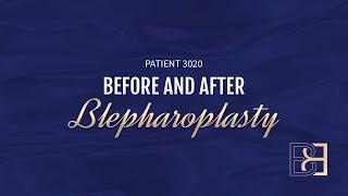 Blepharoplasty (Upper Eyelid Surgery) {Patient 3020} Before & After