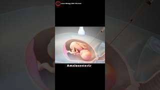 What is an amniocentesis ? Amniotic fluid check up !