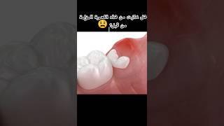 اصعب الم في العالم #التهاب_ضرس_العقل#pericor  onitis #dentist #소아치과 #anesthesia #wisdomteeth