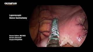 Laparoscopic Sleeve Gastrectomy - THUNDERBEAT - Olympus Surgical - Dr. Naveen Ballem