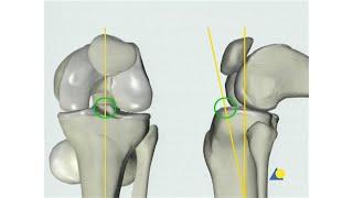 Tibia - Fracture - Intramedullary Nailing with the Expert Tibial Nail (Without Reaming)