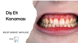 Diş Etlerinde Kanamanın Sebepleri Nelerdir? Dr. Dt. Servet Akyıldız - Suadiye Klinik+1 Diş Kliniği