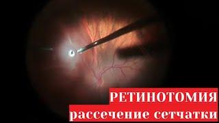 Ретинотомия - рассечение сетчатки глаза