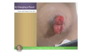 Pediatric Colostomy/Ileostomy: Changing a Pouch