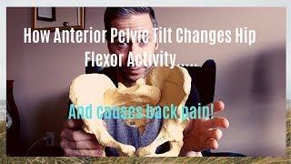 Hip Flexor Mechanics and Problems with Anterior Pelvic Tilt