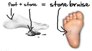 Stone Bruise Foot Pain *HOME Treatment*