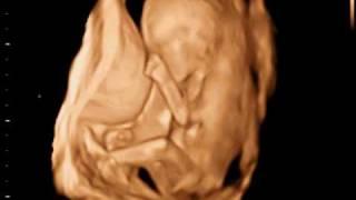 3D Ultrasound Video clip made at 3D Sono Image