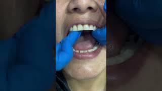 invisible teeth  flexible #viral #dentalhealth #mrdent