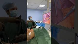 Fastest Weight Loss I Obesity Surgery I Fat Removal Operation I India I Gujarat