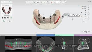 3DBioCAD - 3Shape Implant Studio 무치아: 임플란트 시술계획법