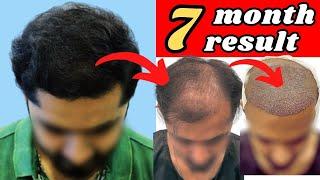 UNBELIEVABLE TRANSFORMATION: 7 MONTH HAIR TRANSPLANT RESULT  #hairtransplant