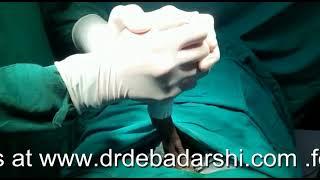 Stapler Circumcision by Dr Debadarshi Rath