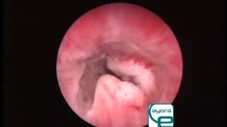 Veterinary Endoscopy: Transitional cell carcinoma in dog: urethrocystoscopy.