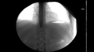 What Happens INSIDE a Sword Swallower: Moving X-ray of Sword Swallower Dan Meyer