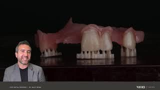 Digital Partial Dentures