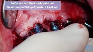 Extraktion-Implantation und sofortige Belastung des Kiefers mit Axiom® Multi Level® - Dr. G. Becker