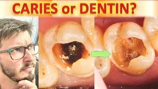 Until Where to Remove Caries on Dentin? (TUTORIAL: Operative Dentistry: How to: Radiology Detection)